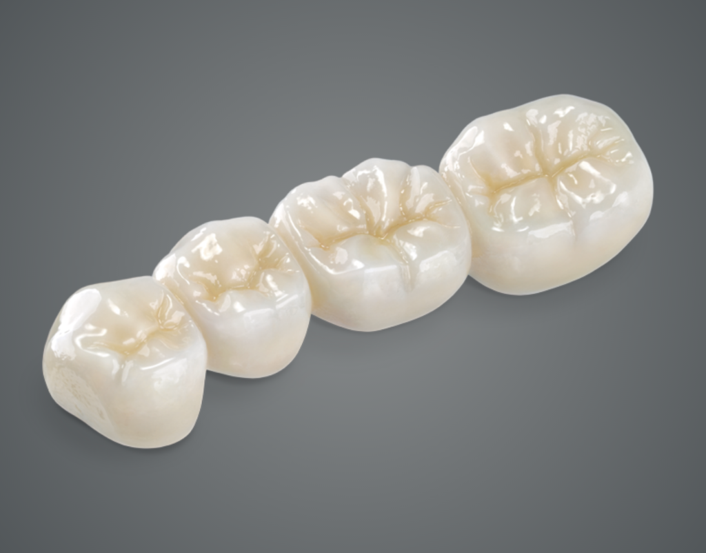 ScrewRetained Crown Peterson Dental Laboratory