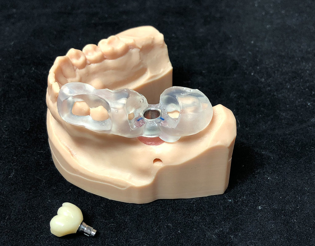 Tooth-Supported-Guides-9
