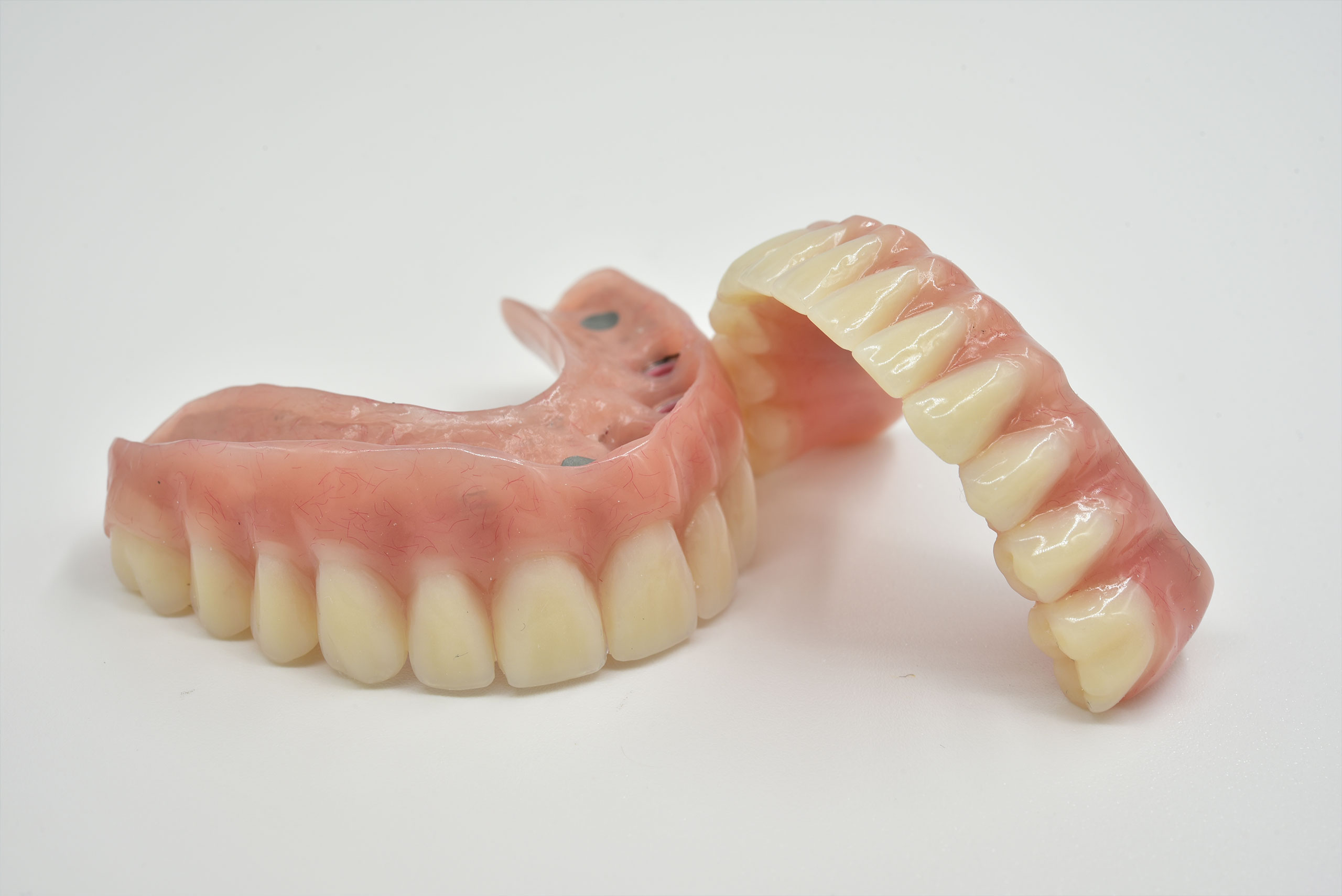 full-arch-removable-locator-overdenture