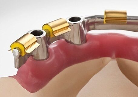 Hader Bar Overdenture Hader Bar Overdenture