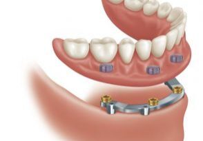 Locator Bar Overdenture Locator Bar Overdenture